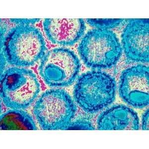 Virology Electron Micrograph Herpes Simplex Viruses Acute Eruption 