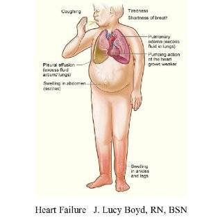 The Patients Guide to Heart Failure Complex Issues Explained Simply 
